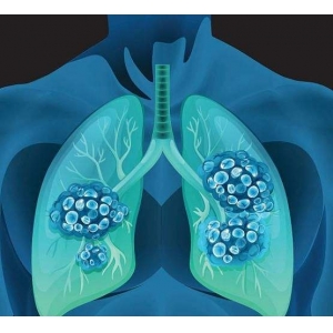肺癌的四大特点